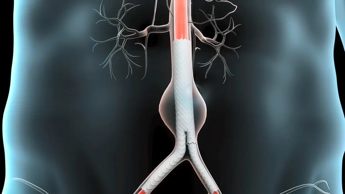 Aortic Aneurysm