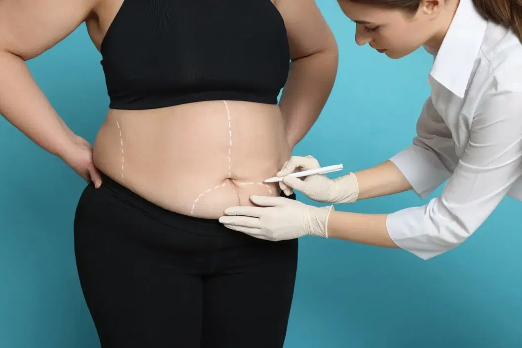 Bariatric Surgery