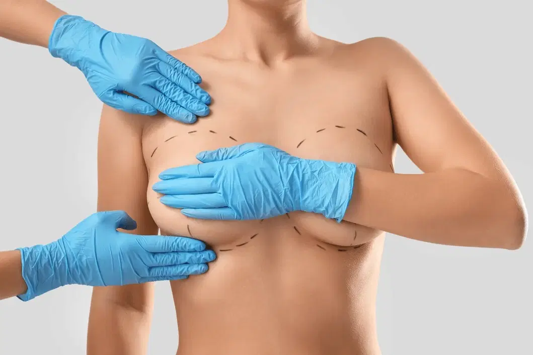 Breast Augmentation