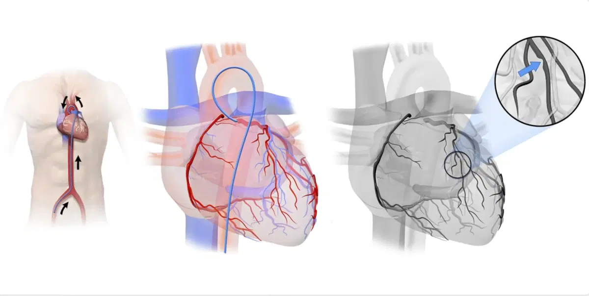 Coronary Angiography