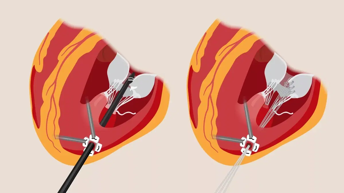 Heart Valve Repair