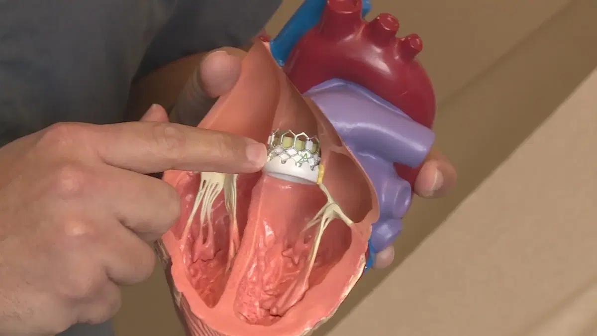 TAVI TAVR